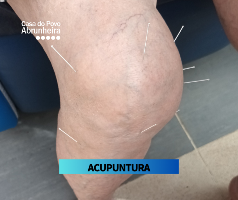 Joelho de um idoso com agulhas de acupuntura